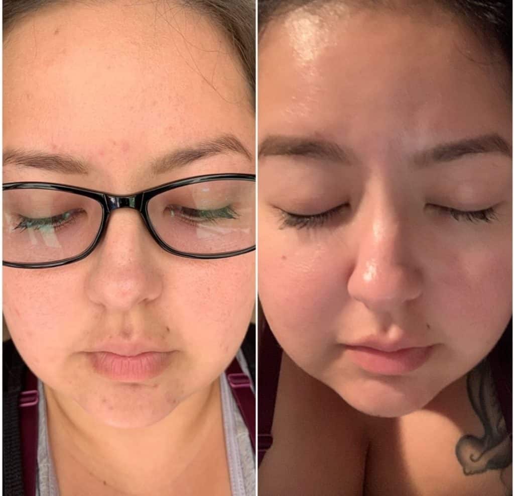 before and after postpartum acne - mom after baby