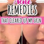 Natural Postpartum Acne Remedies All Moms Need to Try