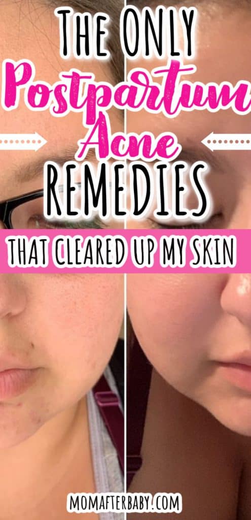 Natural Postpartum Acne Remedies All Moms Need to Try