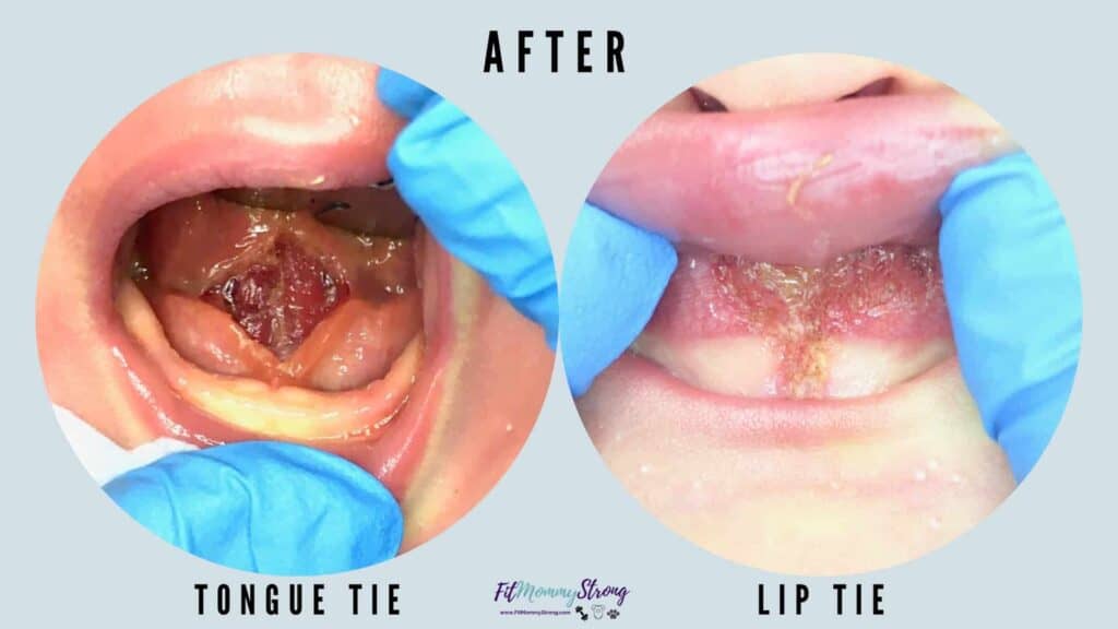 Infant tongue and lip tie AFTER