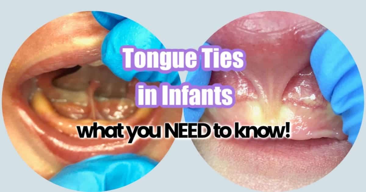 Tongue Tie in Infants – what you need to know!