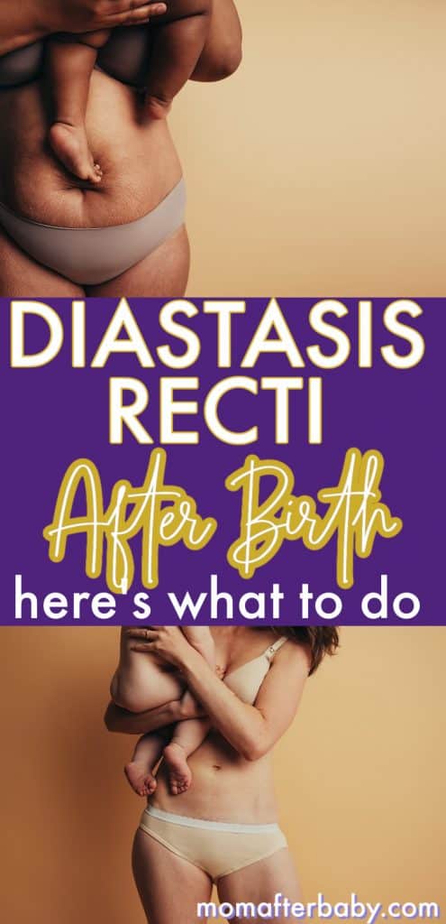 Dealing with Postpartum Diastasis Recti