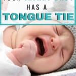infant baby tongue tie