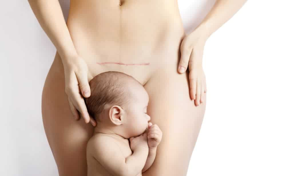 cesarean scar