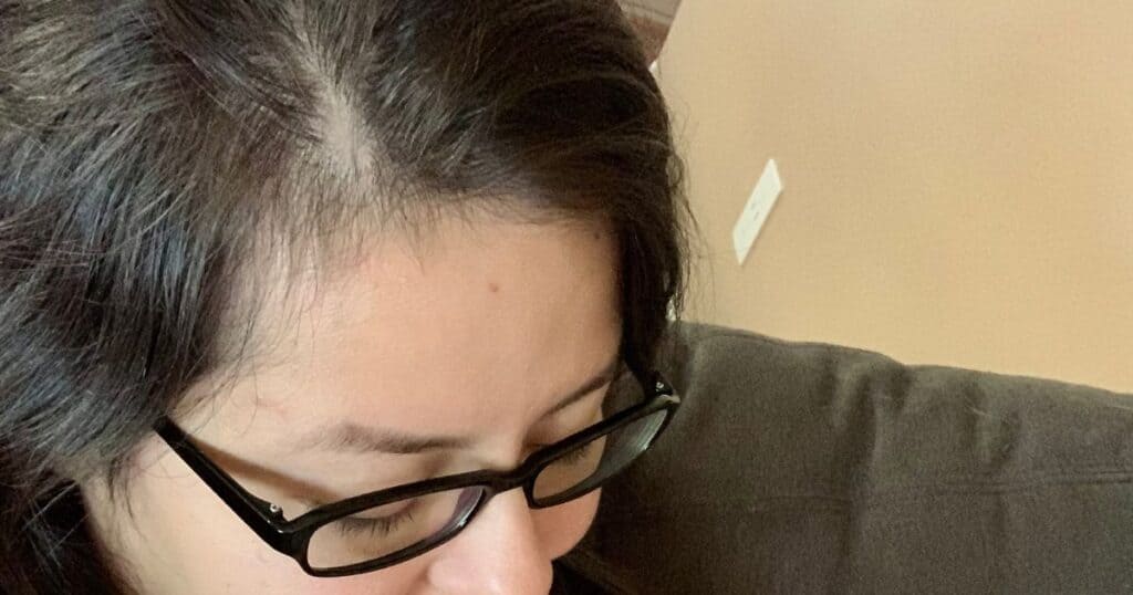 close up of woman's hair line as she experiences postpartum hair loss